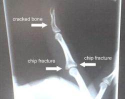 xray of my right hand ring finger showing chip fractures where the middle phalanx meets the proximal phalanx