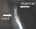 xray of my right hand ring finger showing a break in the distal phalanx